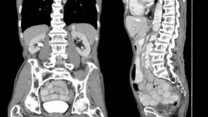 What Does An Abdominal CT Scan Show One Step Diagnostic