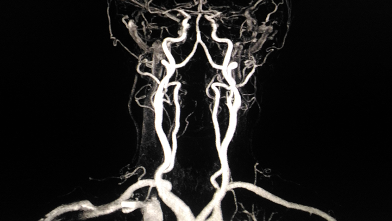 Soft and blurry image,Medical image MRV(magnetic resonance venography) Brain of veins in human head.