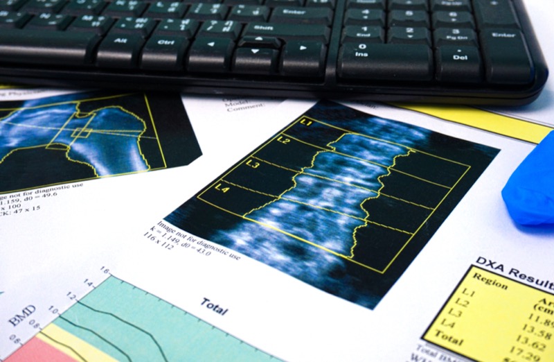 Close up Bone Densitometry Result on the table in room doctor.Healthcare and technology concept.