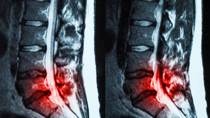 Magnetic resonance imaging (MRI) of lumbo-sacral spines demonstrating herniated disc at L3-L4 and L4-L5 with red color