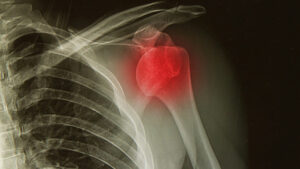 x-rays image of the painful or injury shoulder joint ,shoulder dislocation