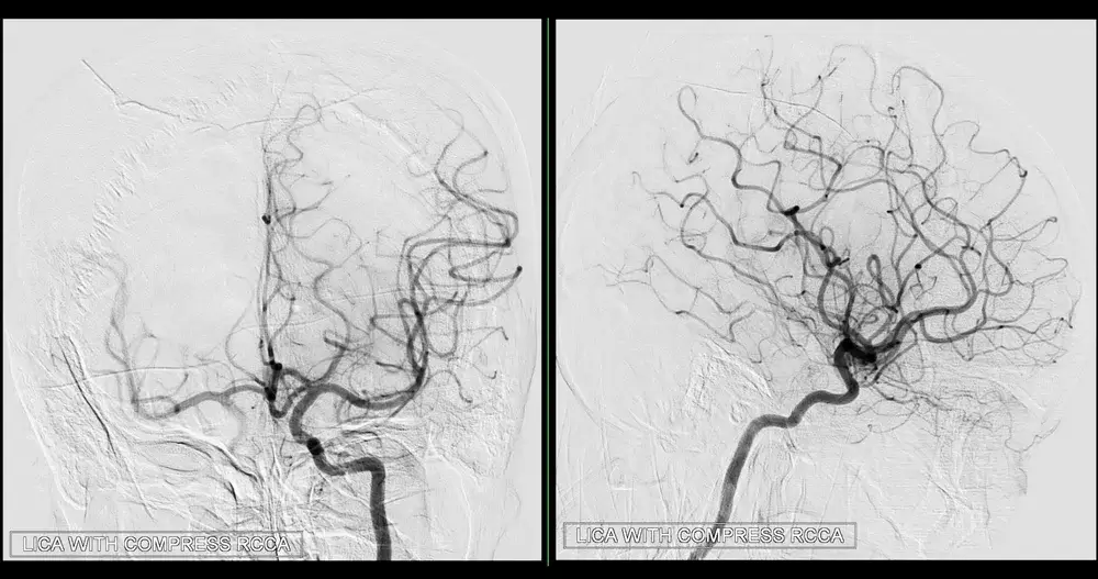 Cerebral angiography image from Fluoroscopy in intervention radiology showing cerebral artery.