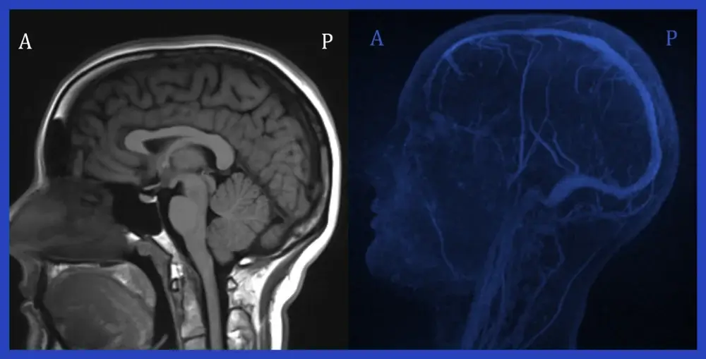 MRI Scan of Brain/ Sagittal view and MR Venograph