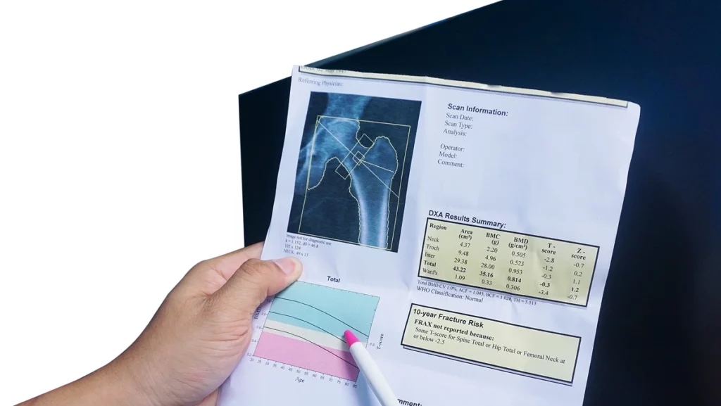 (BMD) DEXA densitometry hip scan. Osteopenia present, frequent precursor to osteoporosis on pen point on white background.Medical healthcare concept.