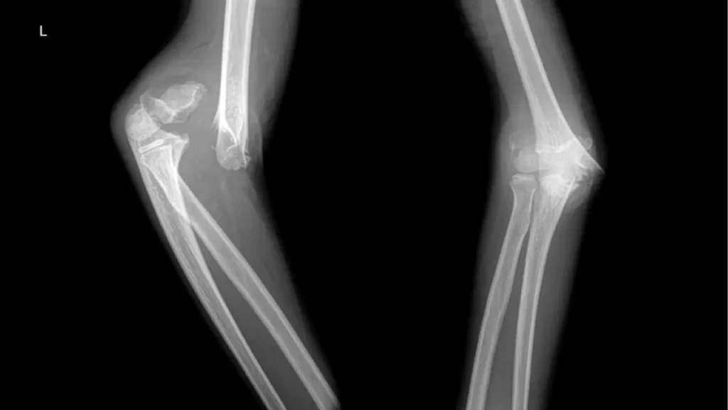 X ray radiography of a child elbow with a humerus fracture.