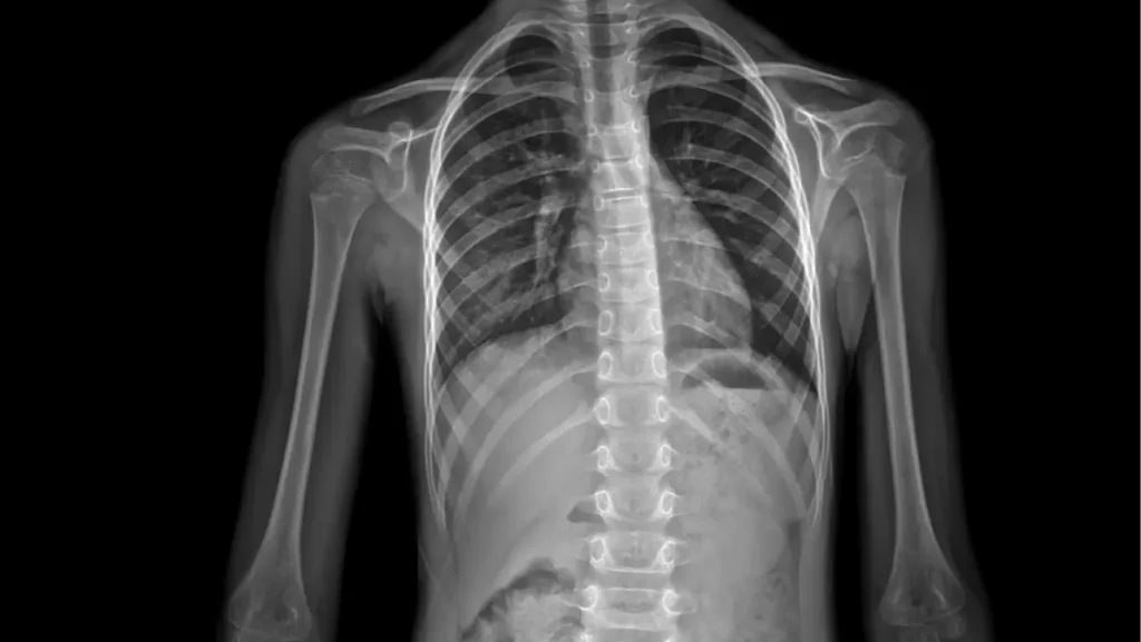 X-ray of childhood scoliosis. Spinal curvature of 6 year old child due to passive lifestyle and spending lot of time at computer and other gaming consoles. Harmful consequences of sedentary lifestyle