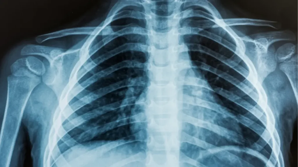 View of a child x-ray film, taken to examine the lungs